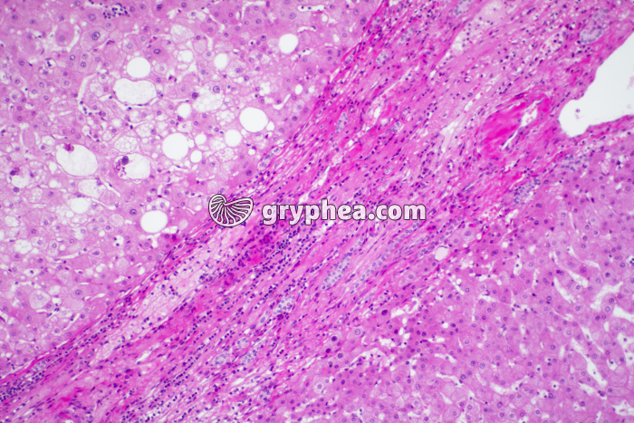 Foie pathologique x40 - gryphea.org